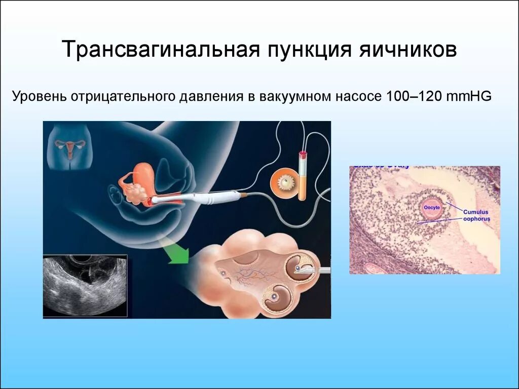 Боли после пункции фолликулов. Трансвагинальная пункция. Пункция забора яйцеклетки. Эко пункция яйцеклеток. Трансвагинальная пункция яичников.