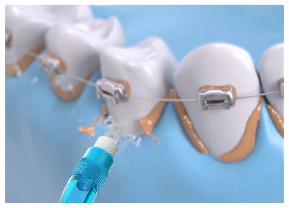 Насадки для ультразвука хирургического при синуслифтинге. Сменные насадки для ирригатора xiaomi soocas w3. Ирригатор soocas w3 pro. Ирригатор xiaomi soocas w3 зарядка. Xiaomi ирригатор для полости рта xiaomi soocas w3 pro.