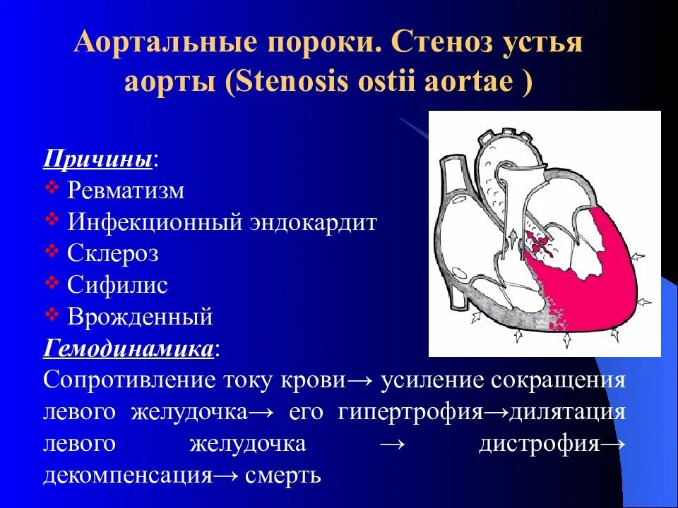 Стеноз аортального клапана сердца. Гемодинамика при порока сердца аортальный стеноз. врожденный порок митрального клапана. приобретенные пороки сердца (митральные и аортальные). врожденный аортальный порок сердца.