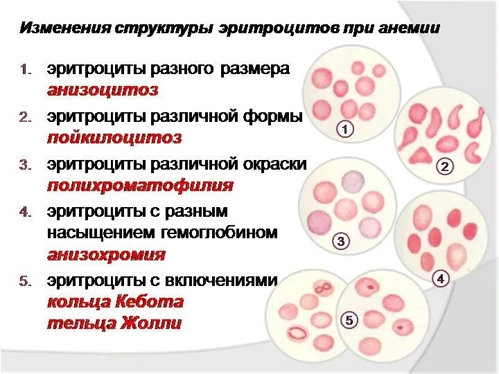 Анизо и пойкилоцитоз при анемии. Изменение формы эритроцитов (пойкилоцитоз). Изменение формы эритроцитов при анемии. Микроцитоз анизоцитоз пойкилоцитоз.