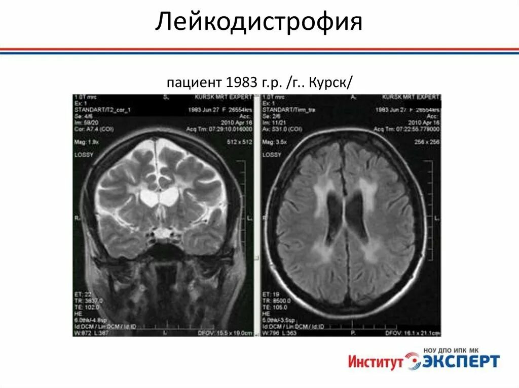 Метахроматическая лейкодистрофия. Лейкодистрофия мрт. Лейкодистрофия Пелицеуса-Мерцбахера. Лейкодистрофия проявление. Органические изменения головного мозга