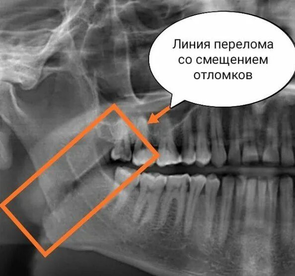 Перелом нижней челюсти рентген. Перелом нижней челюсти без смещения рентген. Ангулярный перелом челюсти. Перелом нижней челюсти со смещением рентген.