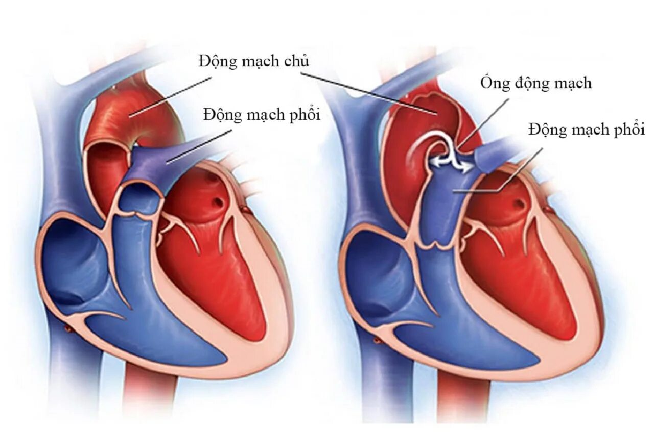 Окно в сердце у ребенка. Порок сердца открытый боталлов проток. Открытый артериальный (боталлов) проток (ОАП. ВПС открытый боталлов проток. Облитерация боталлова протока.