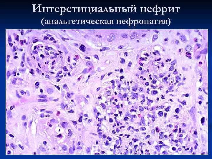 Интерстициальный нефрит патанатомия. Хронический нефрит патанатомия. Острый тубулоинтерстициальный нефрит гистология. Острый интерстициальный нефрит патанатомия. Интерстиций почки