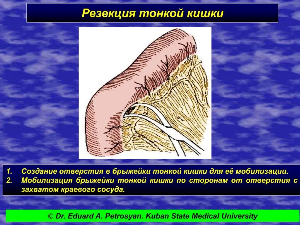 Резекция сегмента. Резекция сегмента