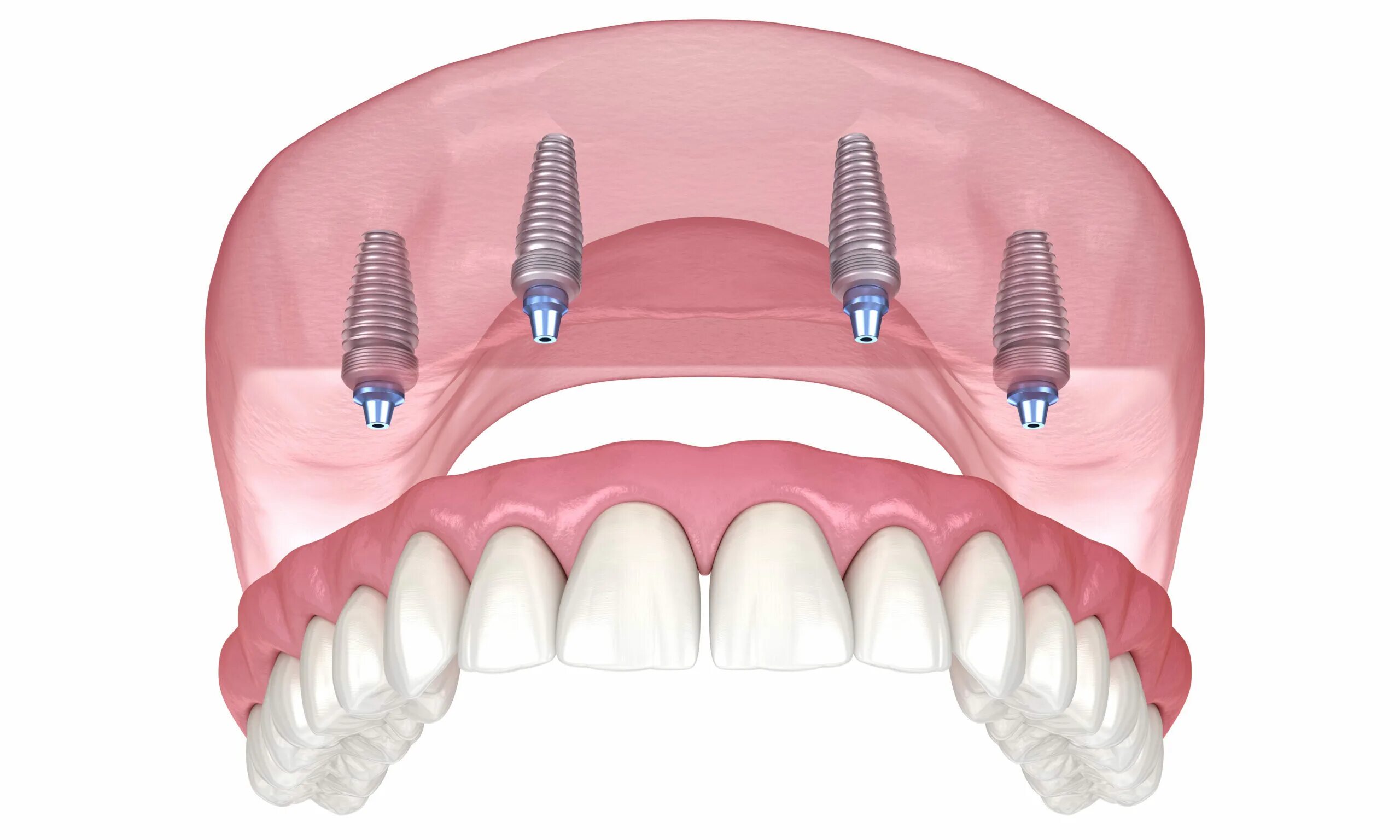 Система имплантации зубов all on 4. Имплантация всей челюсти all on 4. Имплантация верхней челюсти на 4 имплантах. Имплантация all on 4 челюсть.