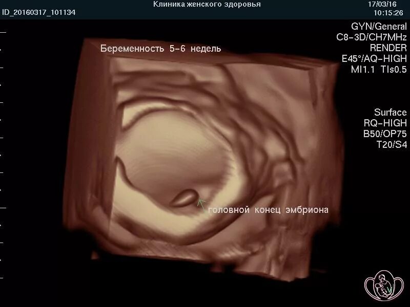Размер эмбриона на 6 неделе. Размер эмбриона на 6 неделе беременности. 6 недель какой плод