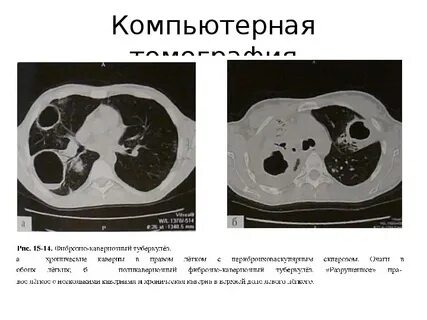Кавернозный туберкулез кт
