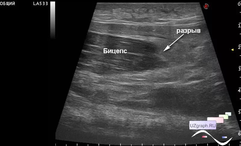 Узи в полный рост. Отрыв сухожилия двуглавой мышцы плеча УЗИ. Двуглавая мышца плеча на УЗИ. Разрыв мышцы на УЗИ. Разрыв двуглавой мышцы плеча на УЗИ.