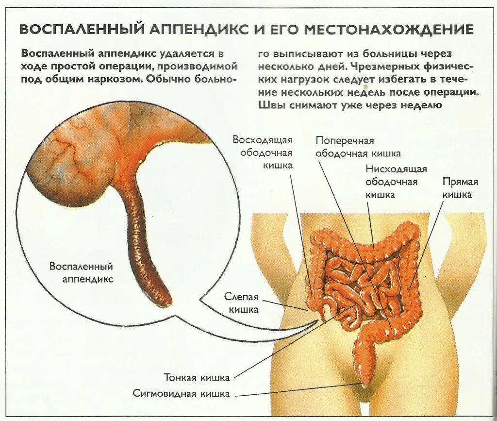 Аппендицит ноющая боль. Воспаленный аппендикс. Расположение аппендицита. Место расположения аппендикса.