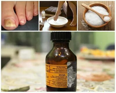 Грибок народный метод