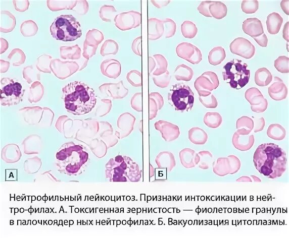 Лейкоцитоз нейтрофилез. Нейтрофильный лейкоцитоз без ядерного сдвига. Нейтрофильный лейкоцитоз картина крови. Лейкоцитоз с нейтрофильным сдвигом. Лейкоцитоз нейтрофилы