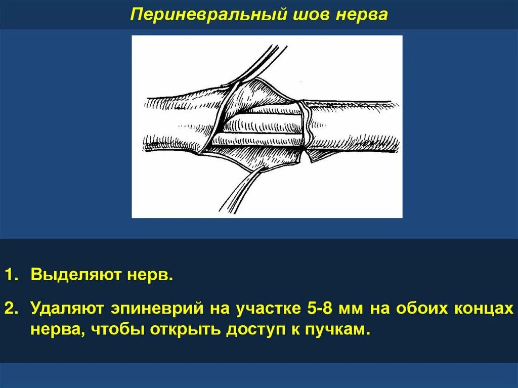 Эпиневральный и периневральный шов. Периневральный шов нерва техника. Шов нерва топографическая анатомия.