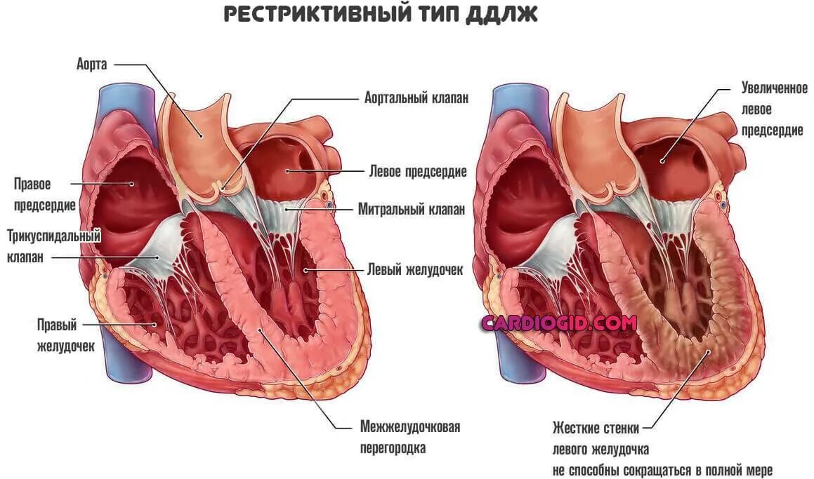 Дисфункции желудочков сердца. Доп хорда левого желудочка. Диастолическая функция левого желудочка сердца. Хорда левого желудочка сердца. Хорды и трабекулы левого желудочка.