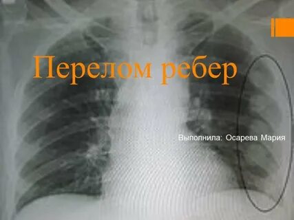 Перелом ребер код 10