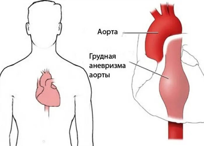 Аневризма сердца что это такое симптомы. Аневризм аорты грудного отдела что это. Атеросклероз брюшного отдела аорты. Аневризма грудной аорты. Разрыв аневризмы грудной аорты.