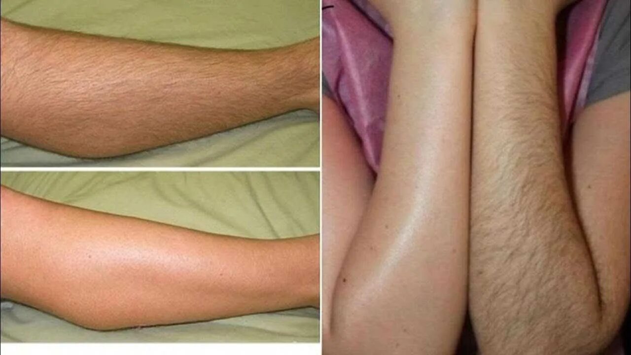 Эпилятор для ног. Волосы 3 мм для лазерной эпиляции. Восковая депиляция. Со скольки лет можно удалять волосы. Волосяной фолликул на электроэпиляции.