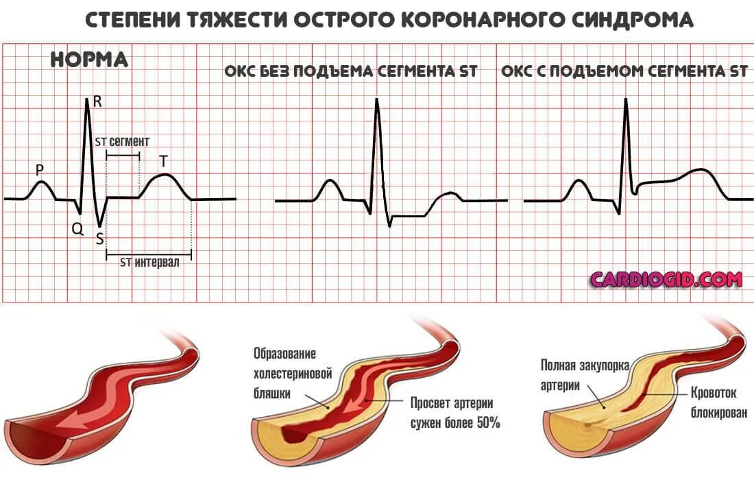 Без подъема st на экг. Инфаркт без подъема St на ЭКГ. Окс без подъема St кардиограмма. Инфаркт миокарда без подъема сегмента St ЭКГ. Подъем сегмента St на ЭКГ на 3 мм.