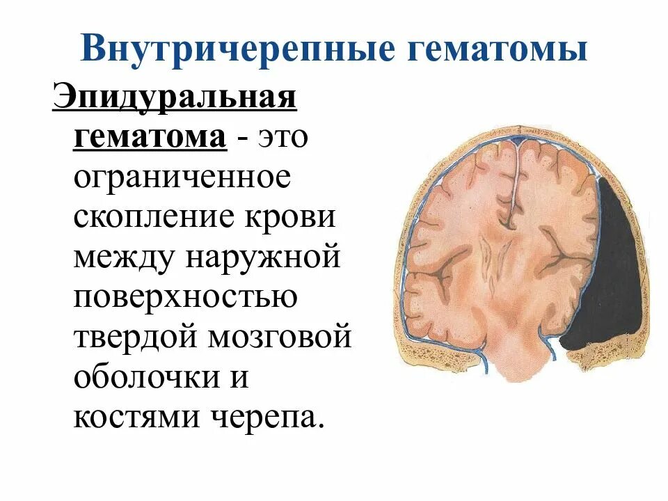 Черепно мозговые гематомы. Субдуральная и эпидуральная гематома. Внутричерепная гематома. Внутричерепное кровоизлияние.