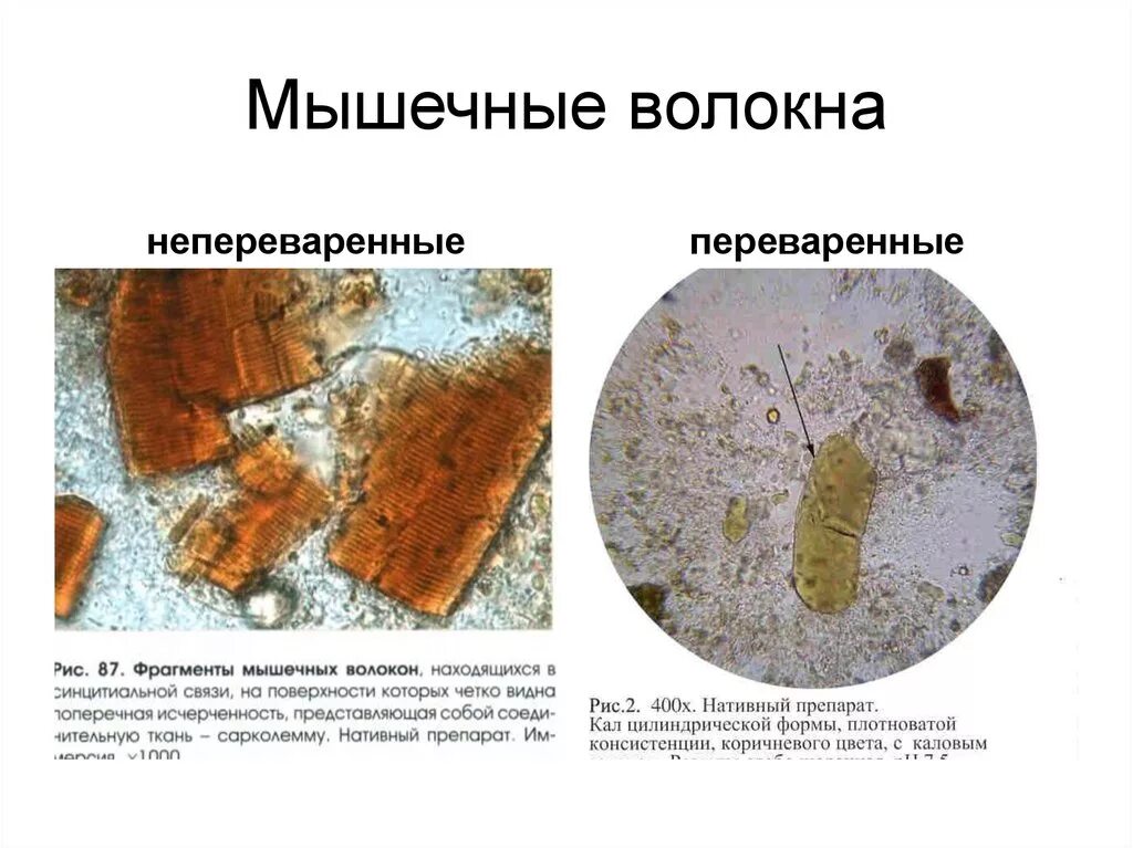 Кальтопроктеин в кале. Микроскопия кала растительная клетчатка непереваримая. Микроскопия кала мышечные волокна. Мышечные волокна с исчерченностью в микроскопии кала. Мышечные волокна с исчерченностью в Кале микроскопия.