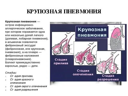 Аускультативные явления характерные для крупозной пневмонии