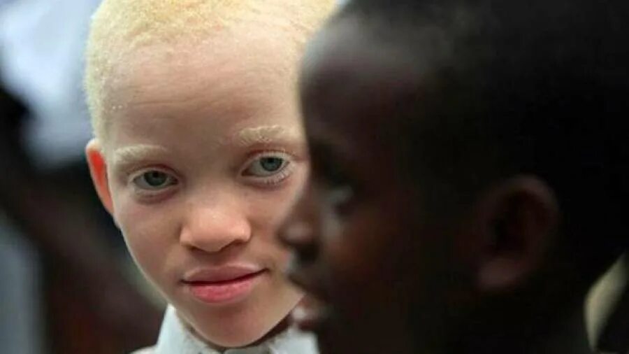 Может ли у белого родится черный. Альбинос негроидной расы. Альбинизм негроидная раса. Белый негр.