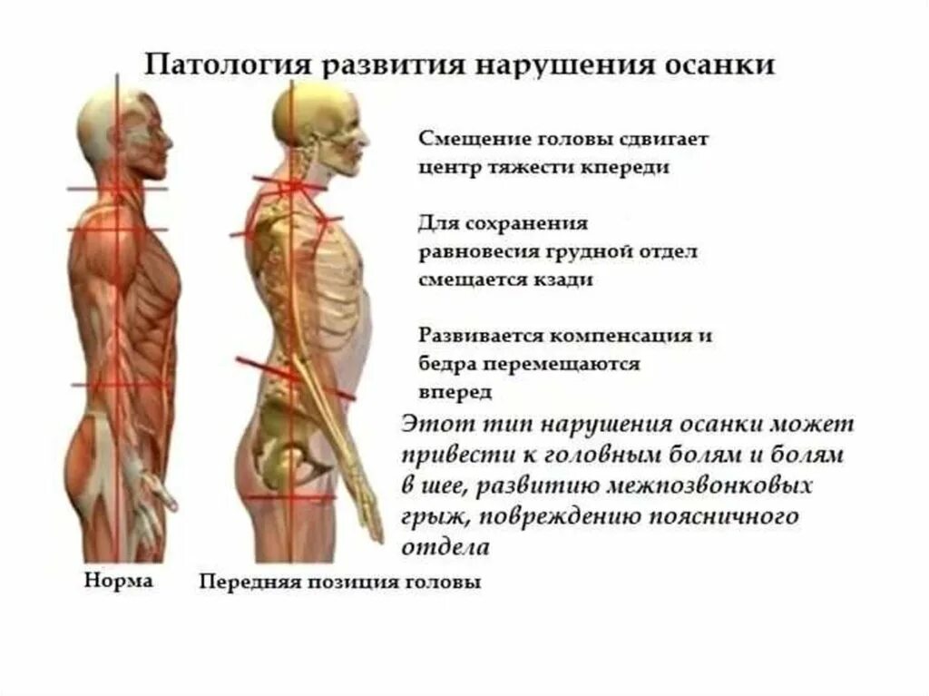 Перекрестный синдром мышц. Мышцы осанки. Мышцы поддерживающие осанку. Патология развития нарушения осанки.