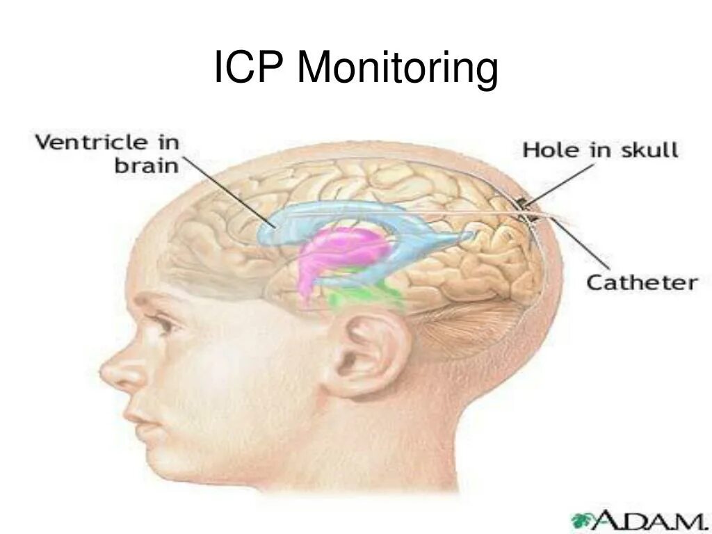 Внутричерепное давление головного мозга. Гидроцефалия головного мозга. Наружная гидроцефалия.