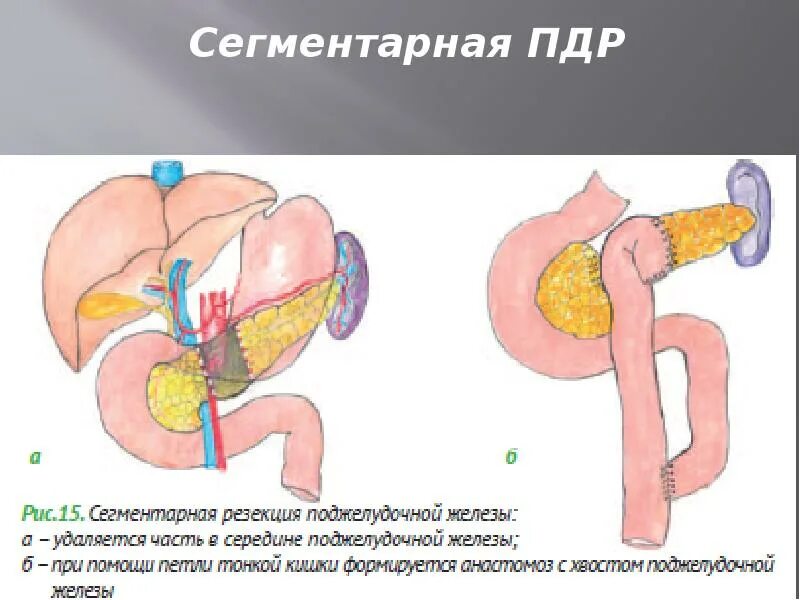 Пдр операция. ПДР поджелудочная железа. Операция ПДР на поджелудочной железы.