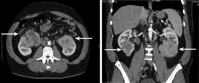 Почечно клеточная карцинома кт. Папиллярная карцинома почки кт.