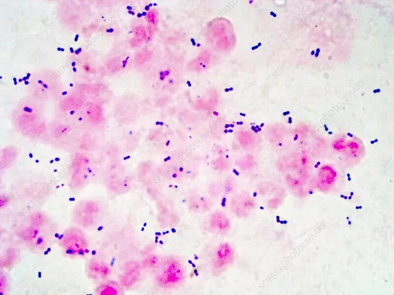 Streptococcus pneumoniae микроскопия. Стрептококк пневмония мазок.