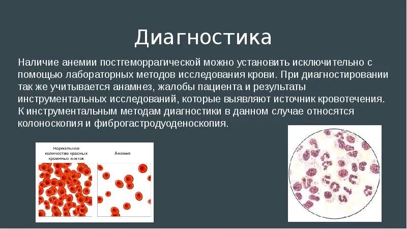 Анемия в моче. Кровь при железодефицитной постгеморрагической анемии. Диагностические критерии острой постгеморрагической анемии. Постгеморрагическая анемия морфологические изменения. Острая постгеморрагическая анемия картина крови.