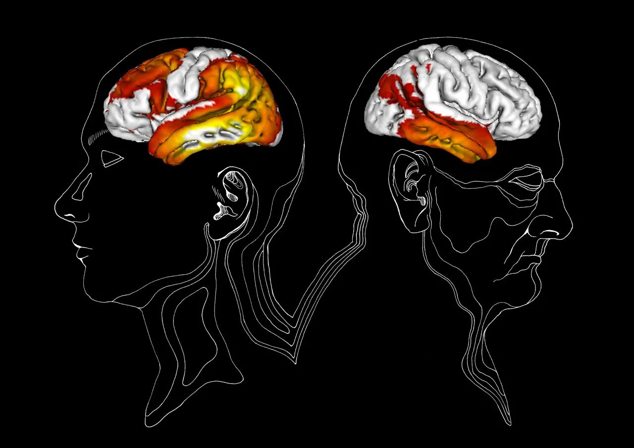 Brain disorder. Альцгеймер арт. Деменция. Деменция мозга Векторная иллюстрация. Альцгеймер рисунок.