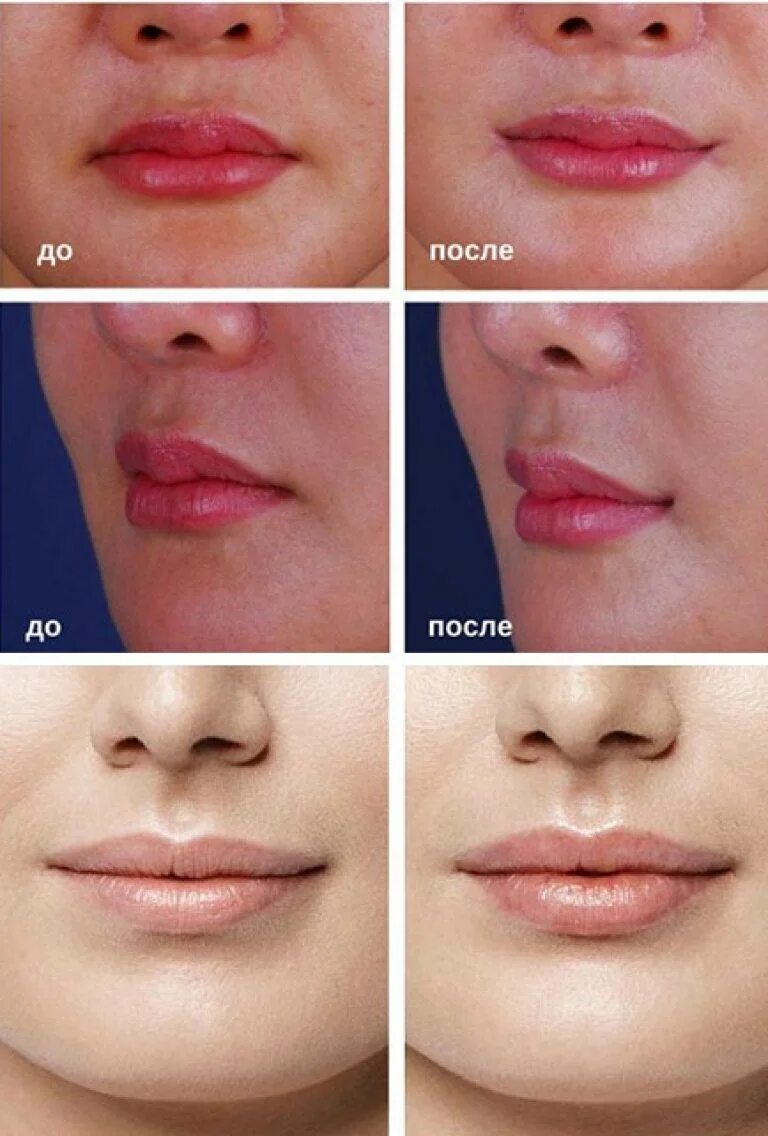 Восстановление губ после. Упражнения для увеличения губ. Гимнастика для губ для увеличения. Гимнастика для губ до и после.