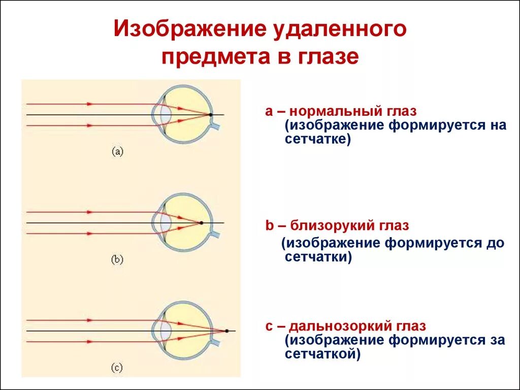 Дополните предложения изображение в близоруком глазу фокусируется