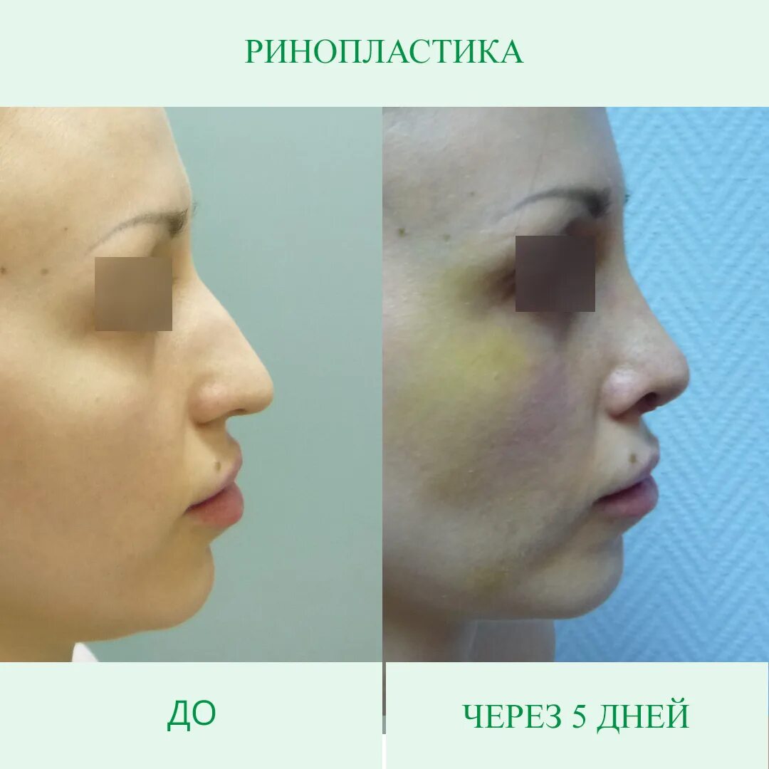 Ринопластика отек. Клювовидный нос ринопластика. джозеф карпю ринопластика. ринопластика кончика носа.