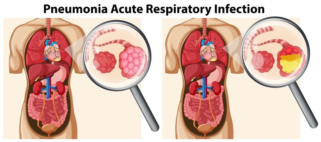 Respiratory failure. Acute respiratory failure. Pneumonia respiratory rate. Pneumonia respiratory rate. Pneumonia respiratory rate.