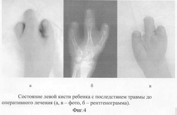 Ампутационная культя пальцев кисти. Повреждения кисти у детей. Восстановление утраченных фаланг пальцев кисти.