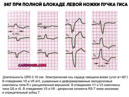 Полная блокада левой ножки