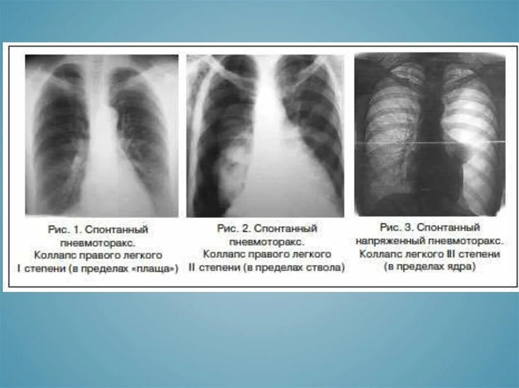 Признаки воздуха в легких. Рентген картина пневмоторакса. Апикальный пневмоторакс рентген. Рентген при пневмотораксе описание. Закрытый спонтанный пневмоторакс рентген.