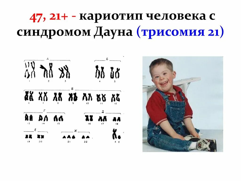 Появление дополнительной хромосомы. Кариотип человека с синдромом Дауна. Болезнь Дауна кариотип. Кариотип болезни синдрома Дауна. Кариограмма хромосом Дауна.