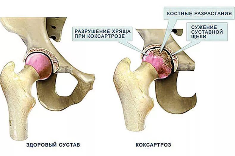 Причина болезни коксартроза