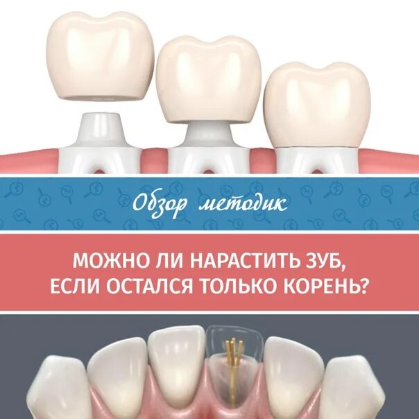 Виниры на зубы из керамики - фото до и после, отзывы в стоматологии