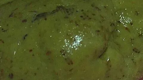 Лямблии в кале у ребенка
