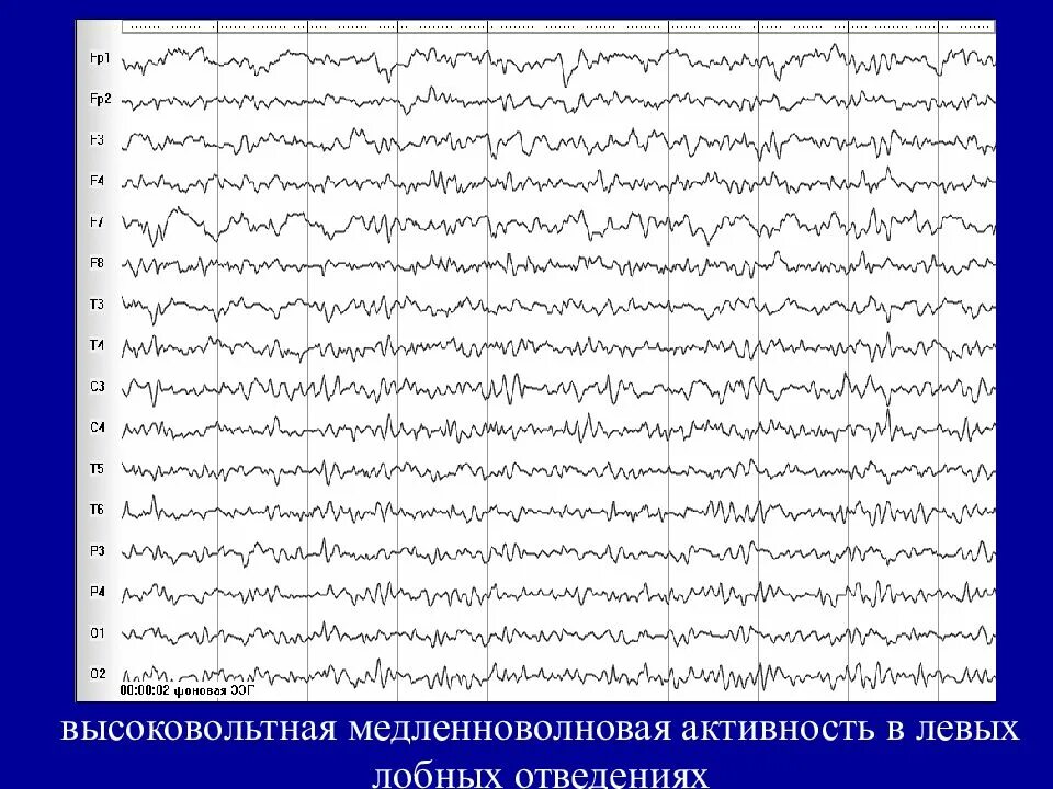Диффузная активность мозга. ЭЭГ норма и патология. Ритмы ЭЭГ В норме и патологии. Электроэнцефалограмма норма и патология. Лобные отведения на ЭЭГ.