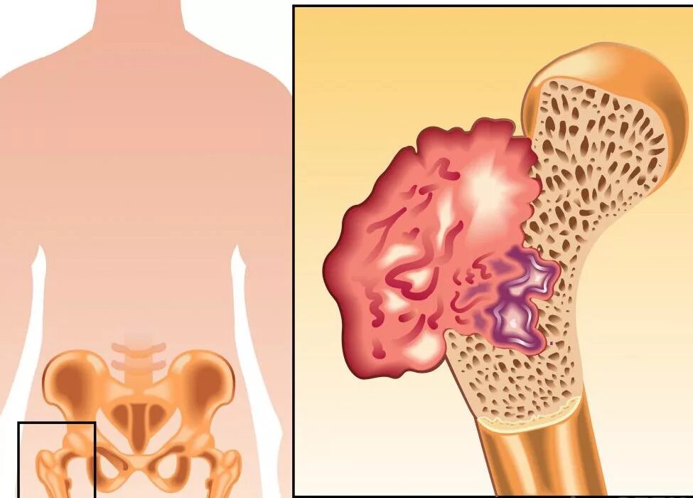 Рак в костях прогноз. Остеосаркома бедренной кости. Остеосаркома тазобедренного сустава. Остеогенная саркома бедренной кости. Саркома костной ткани симптомы.