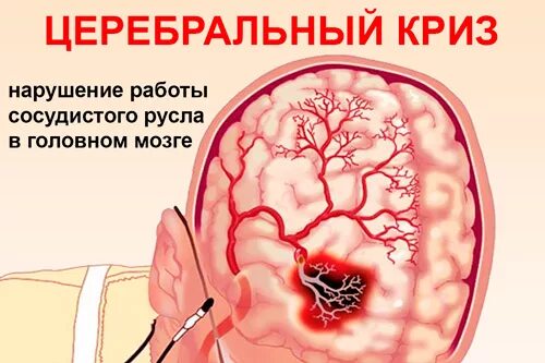 Ишемический криз. Гипертонический церебральный криз. Церебральные симптомы гипертонического криза. Церебральный сосудистый криз. Гипертонический церебральный криз клиника.