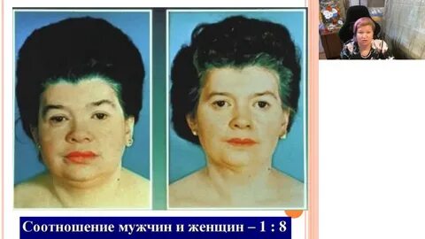 Гипотериоз после лечения