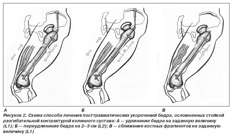 Посттравматический контрактура сустава