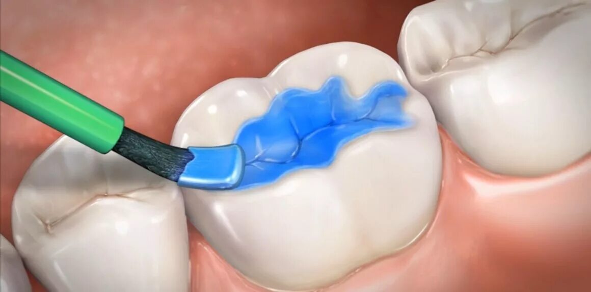 Залить зубы. Герметизация (запечатывание) фиссур. Запечатывание фиссуры зуба герметиком что это. Герметизация фиссур стоматология. Залить зубы.